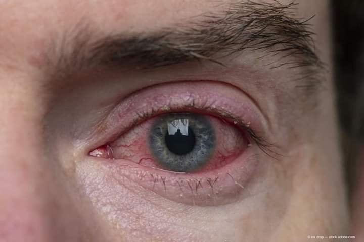 pink eye image